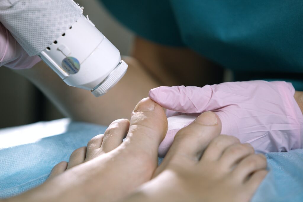 Podiatrist treating onychomycosis with a laser